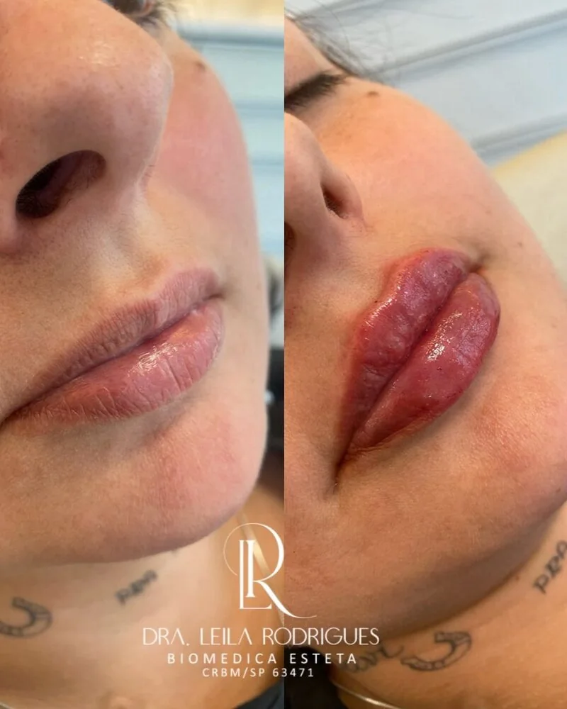 Antes e depois do preenchimento labial: à esquerda os lábios finos, à direita com mais volume e contorno