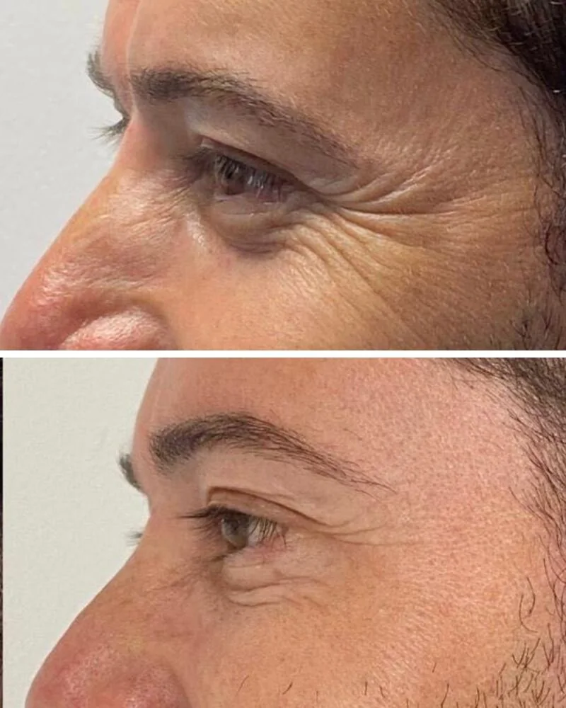 Pés de galinha antes e depois da toxina botulínica, bem mais suaves na foto de baixo