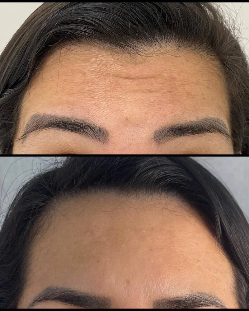 Testa antes e depois da toxina botulínica: linhas marcadas em cima e pele lisa embaixo