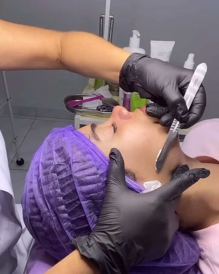 Dermaplaning sendo feito no rosto de uma cliente deitada na maca