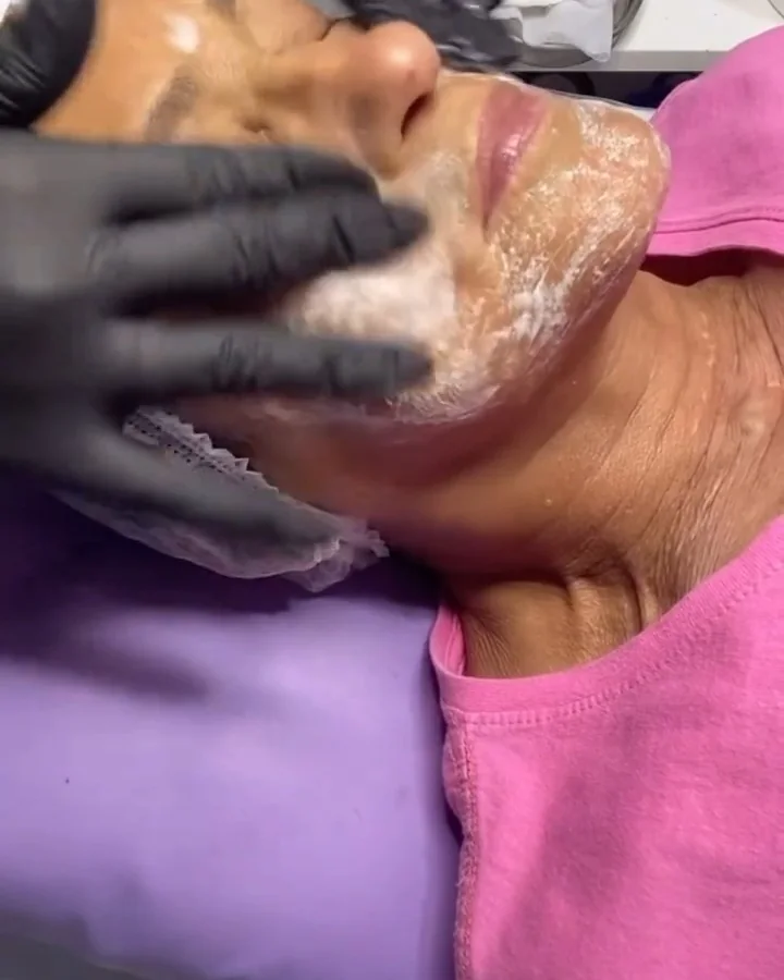 Mãos com luvas aplicando creme no rosto de uma cliente durante a limpeza de pele