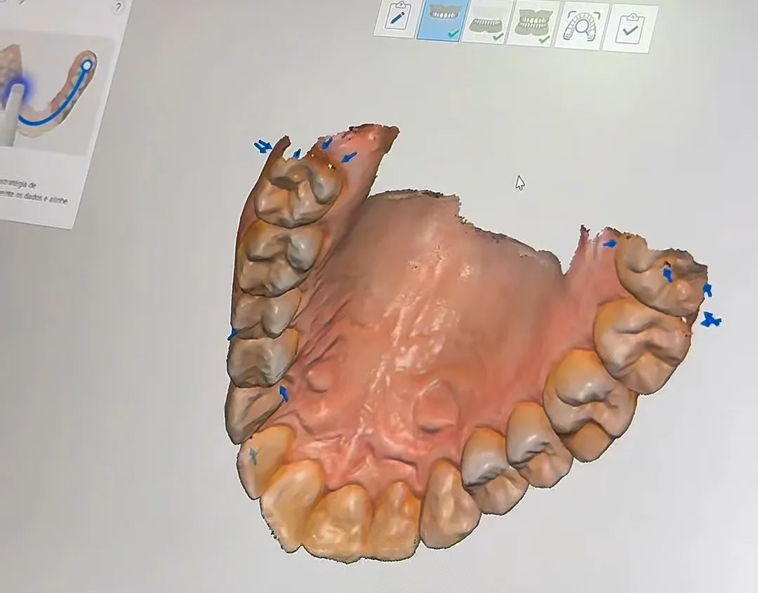 Modelo 3D dos dentes na tela do computador, feito pelo escaneamento digital